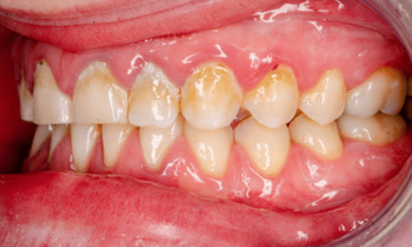 Tartar vs Plaque