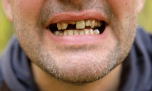 knocked out tooth quality care