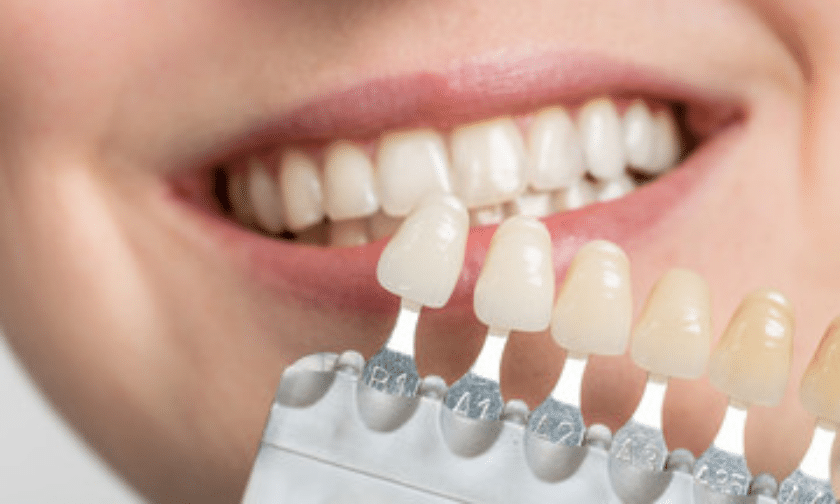 dental veneers benefits