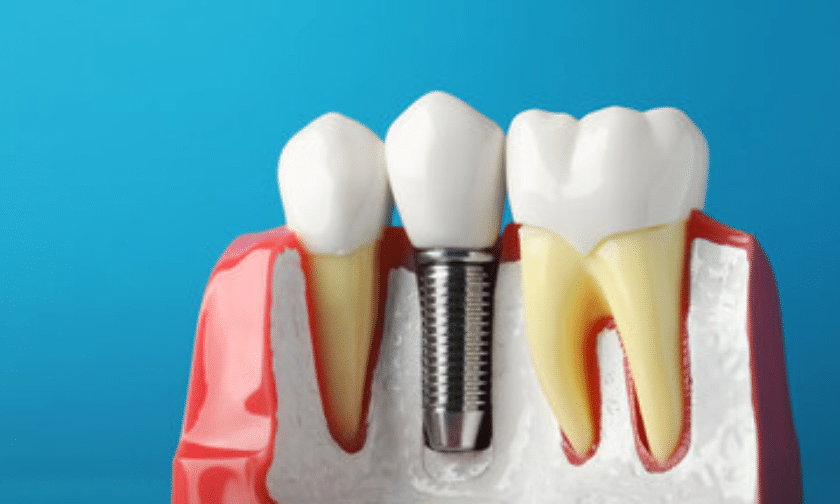 dental implants benefits