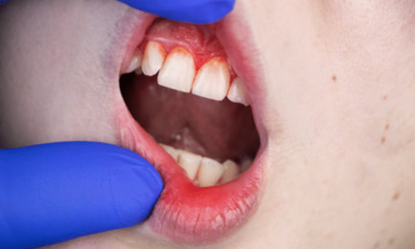 gum disease health complications