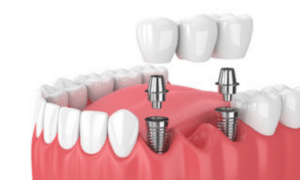 know about dental bridge