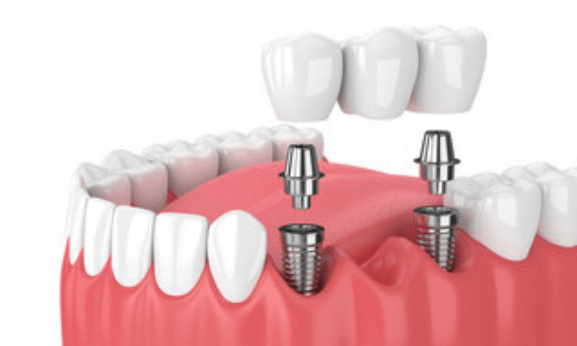 know about dental bridge