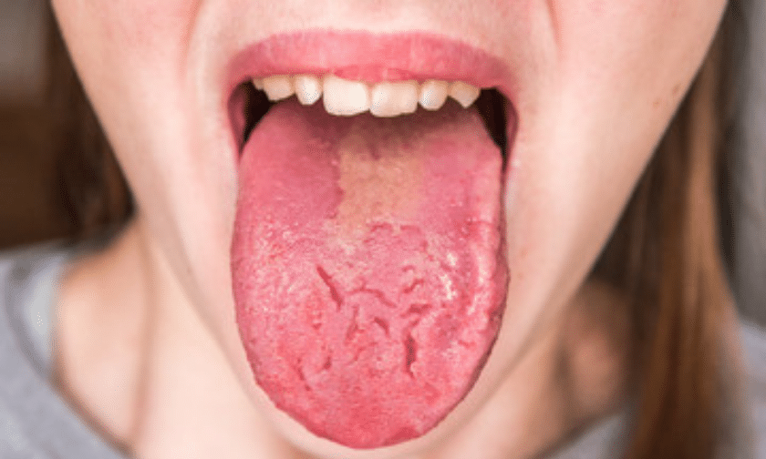 mouth sore