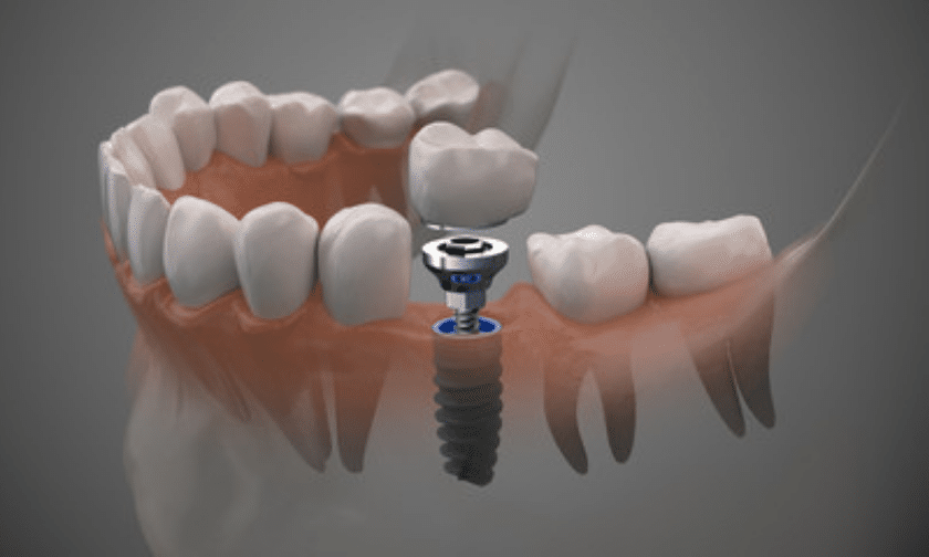 Dental implants replace lost tooth