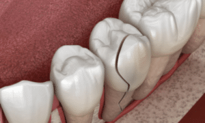 3D illustration of tooth cross-section showing internal decay and root damage from preventable dental disease.