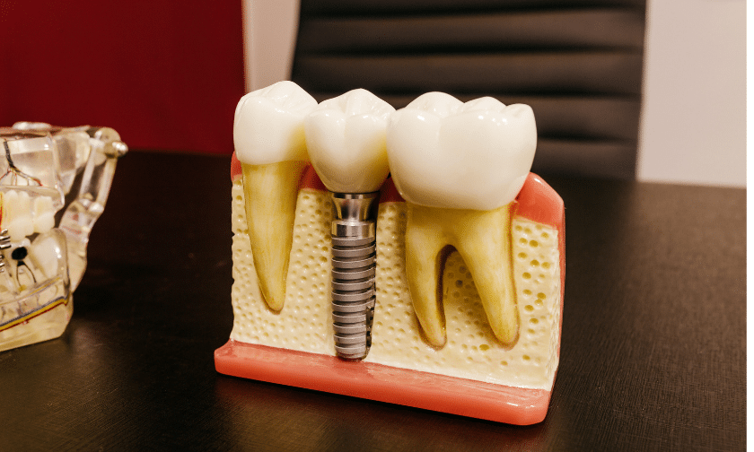 Dental Implants