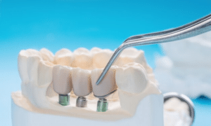 Dental implant bridge model showing three prosthetic teeth on implant abutments with dental mirror.