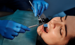 Dental Sealants
