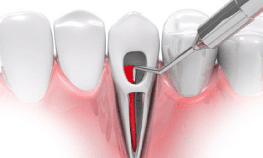 know about root canal