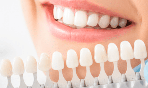 Person smiling displaying white teeth next to dental shade guide comparison samples.