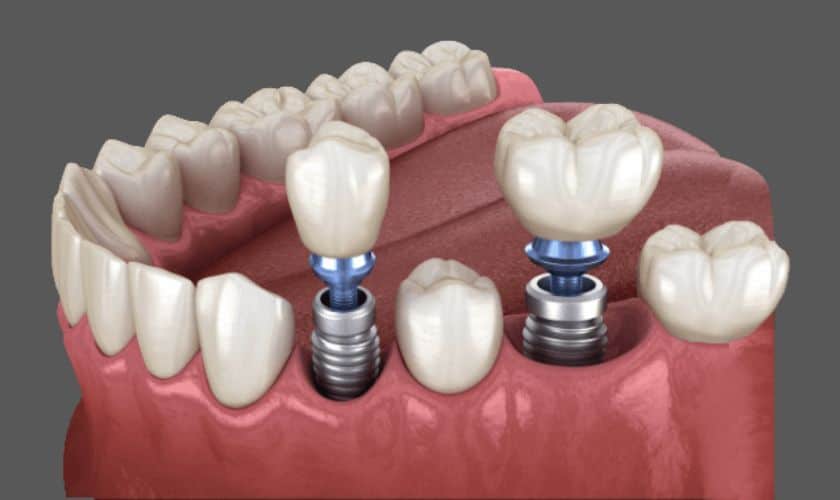 Lifespan Of A Dental Implant