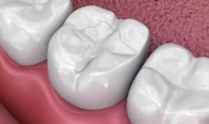 Cavity Fillings