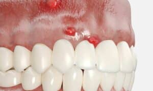 Emergency with a Dental Abscess