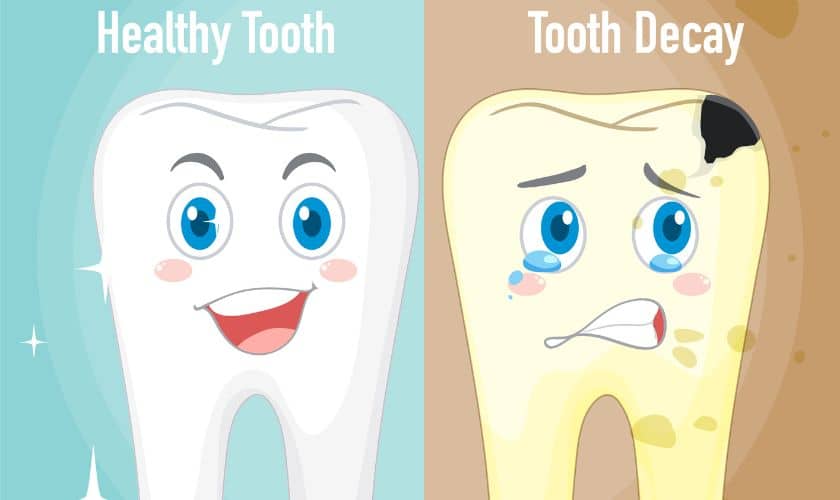 Dental Fillings