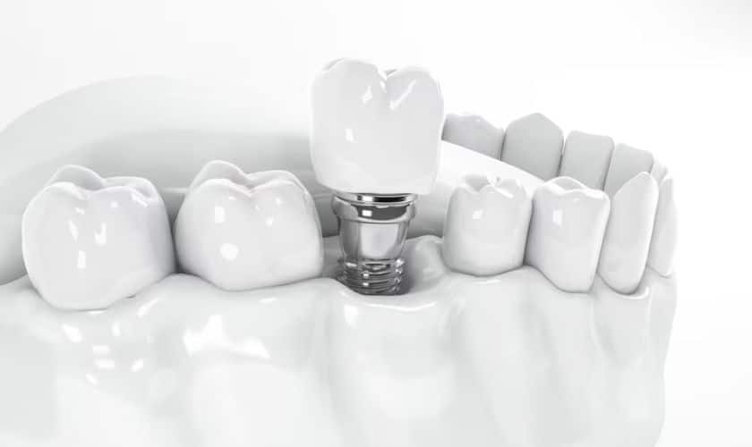 The Long-Term Benefits of Dental Implants