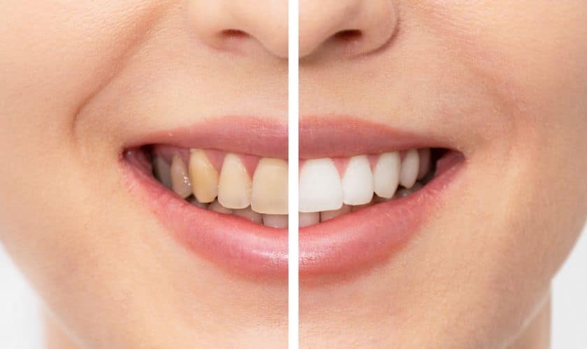 Teeth whitening Orem