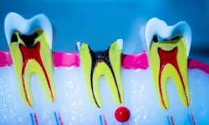 Root Canal Recovery Orem