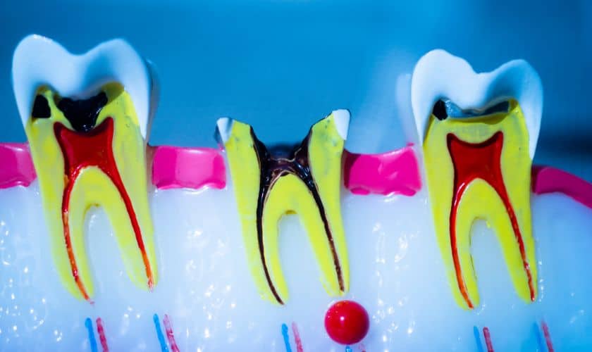 Root Canal Recovery Orem