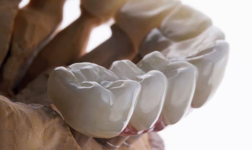 Dental Bridges and Oral Health