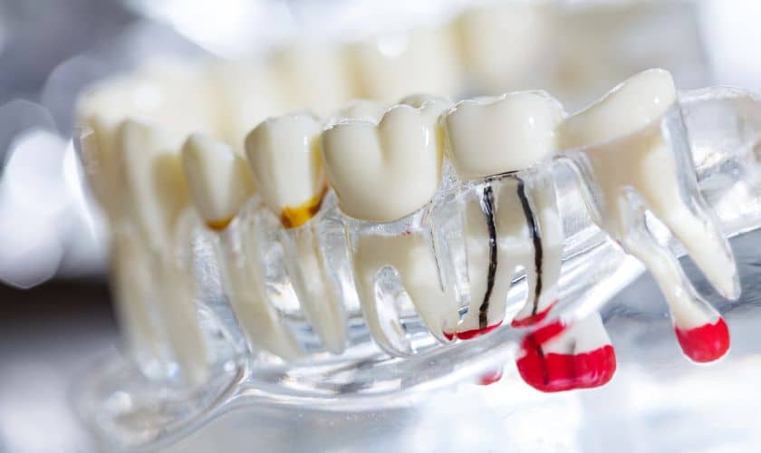 Root Canal Therapy Orem