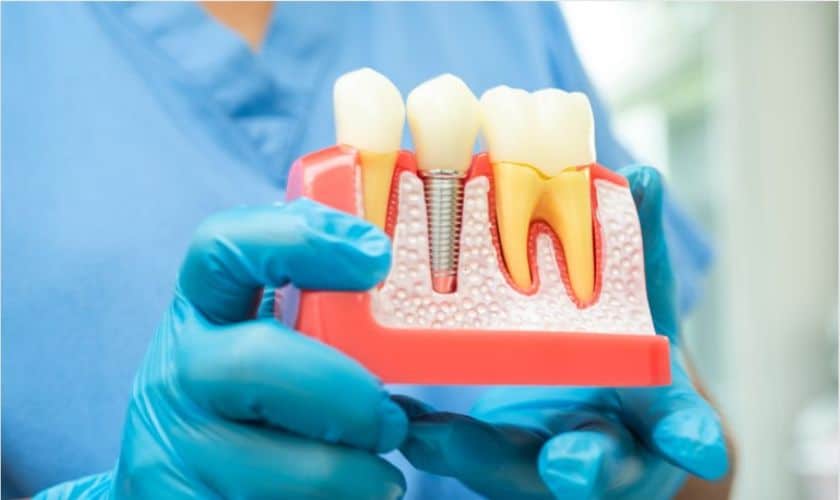 Root Canal Treatments