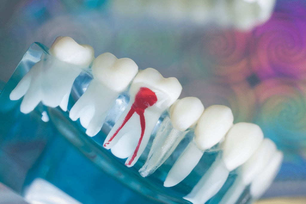 The Transformative Benefits of Root Canal Therapy