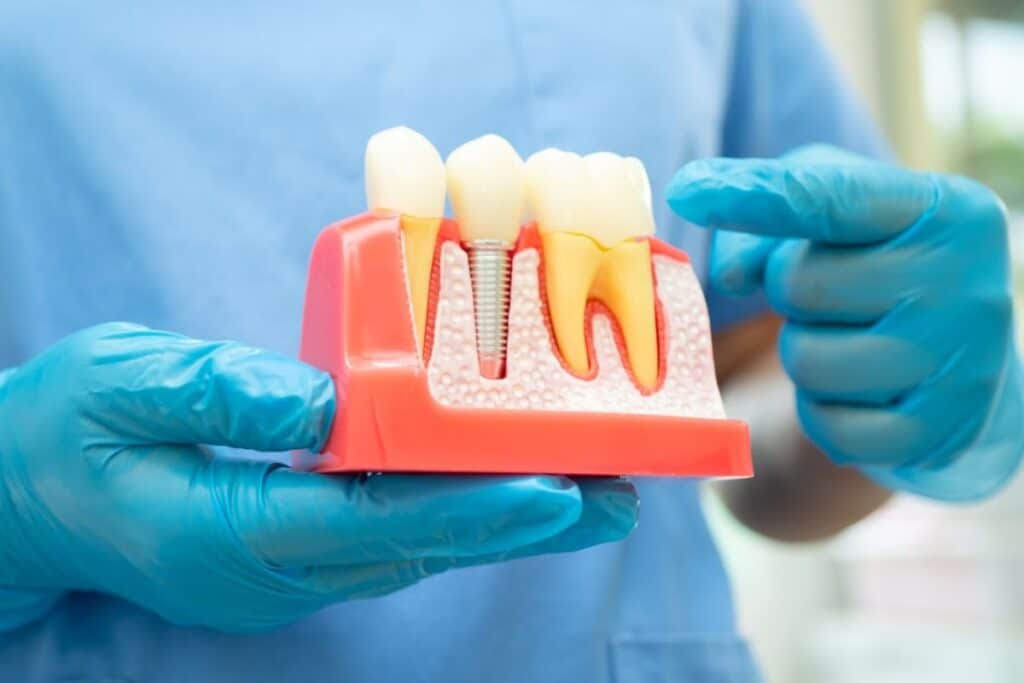 Dental Implants Treatment in Orem